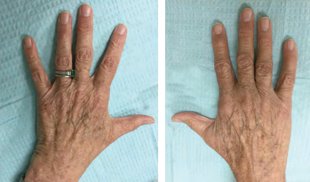 Comparison of the placebo-treated hand at left to the rapamycintreated hand shows that clinical signs of aging were improved in the treated hand.